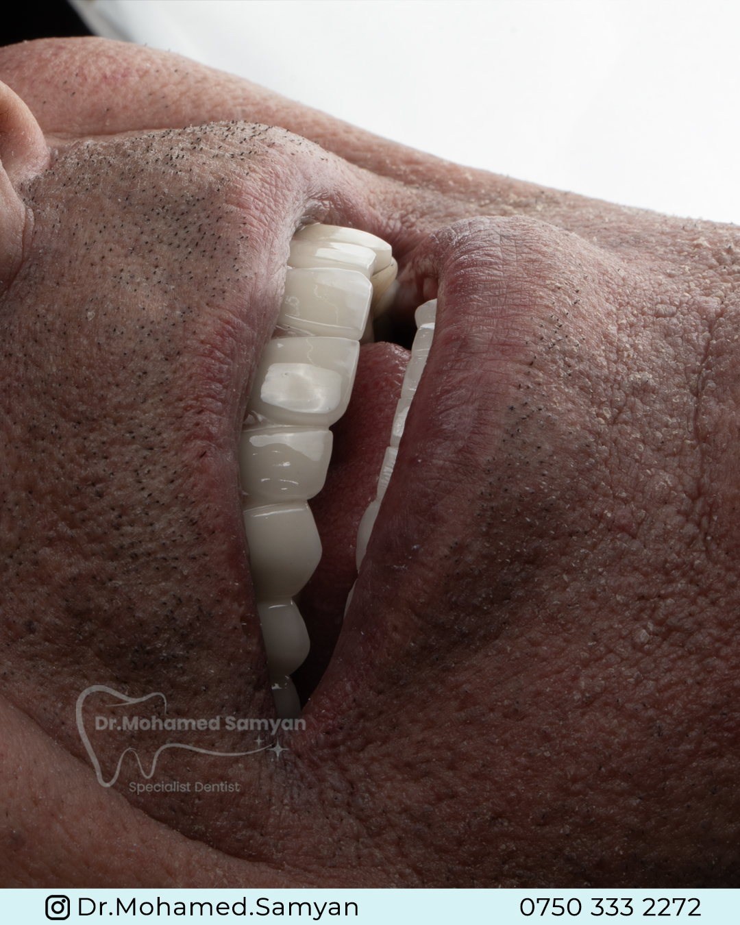 Dental Implant